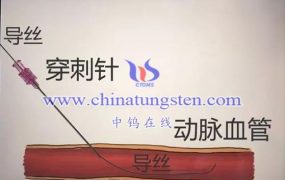 什么是血管内介入手术钨针？